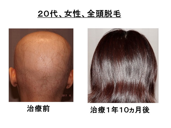 円形脱毛症　病院